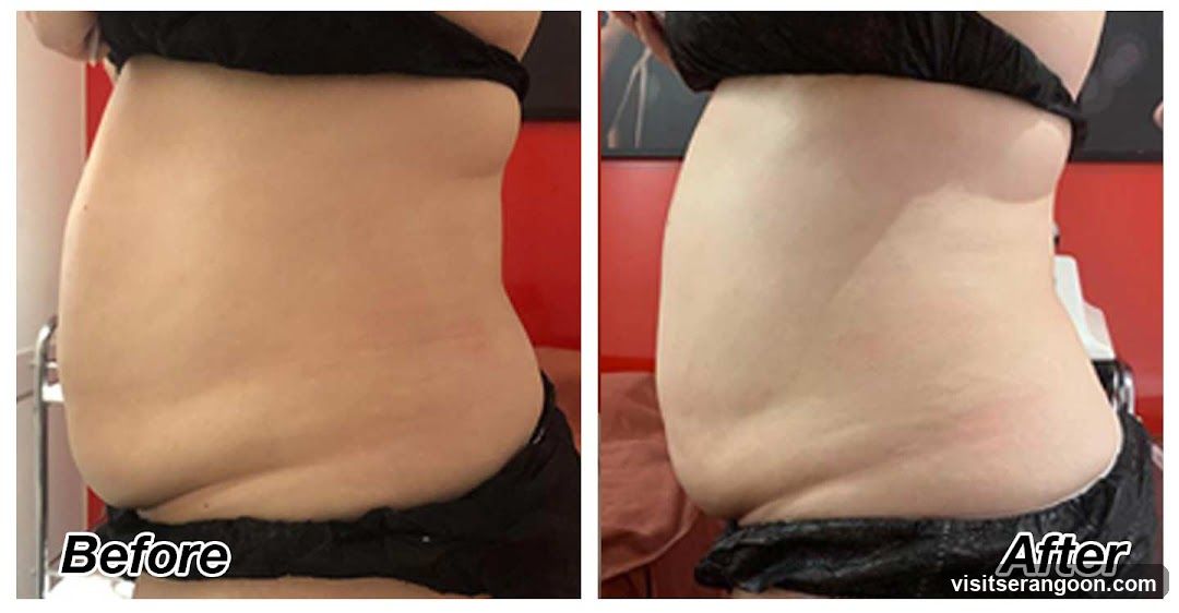 London Weight Management - NEX | SG's #1 Weight Loss & Slimming Expert | Burn Stubborn Fat in 30 Mins