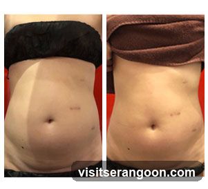 London Weight Management - NEX | SG's #1 Weight Loss & Slimming Expert | Burn Stubborn Fat in 30 Mins