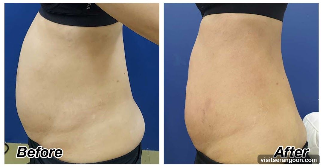 London Weight Management - NEX | SG's #1 Weight Loss & Slimming Expert | Burn Stubborn Fat in 30 Mins